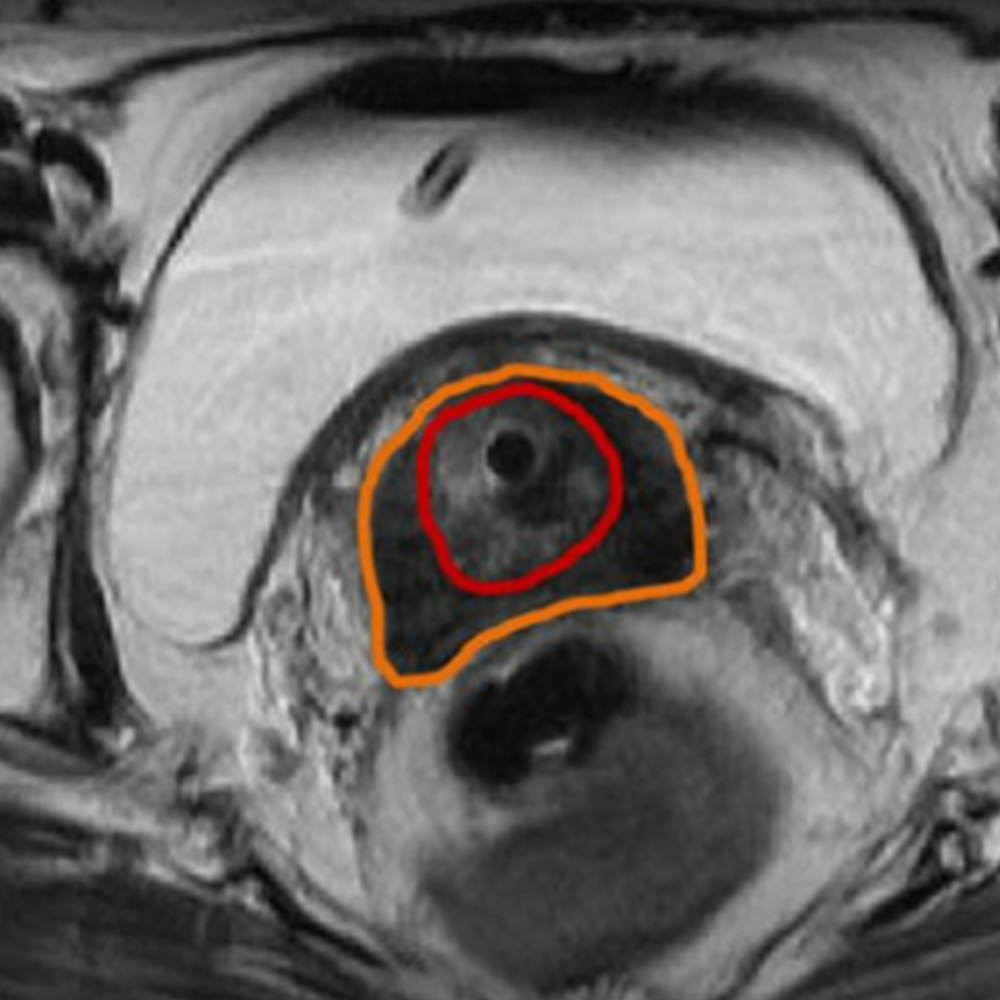 MRI Brachytherapy