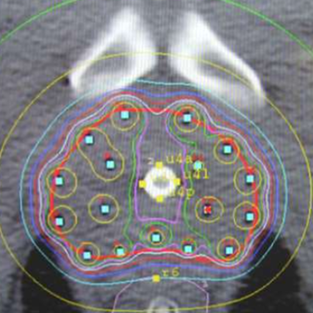 prostate brachytherapy