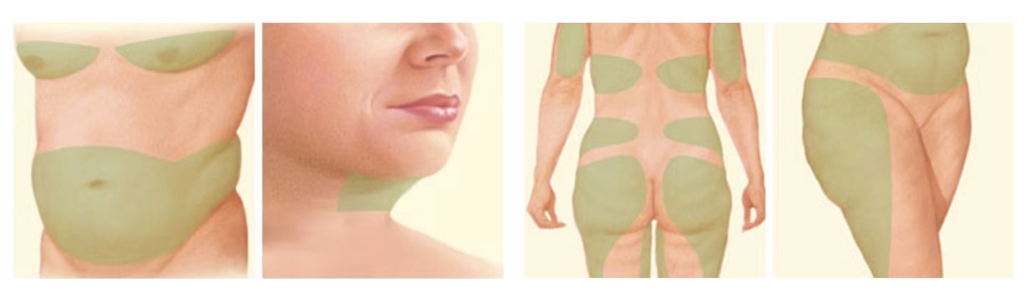 incision