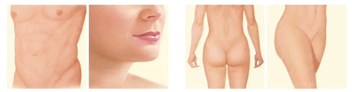 liposuction subside