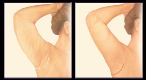 Minimal Incision