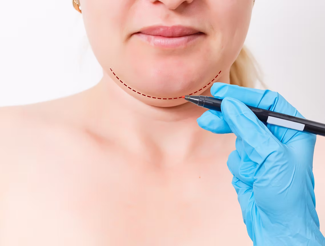 Kybella