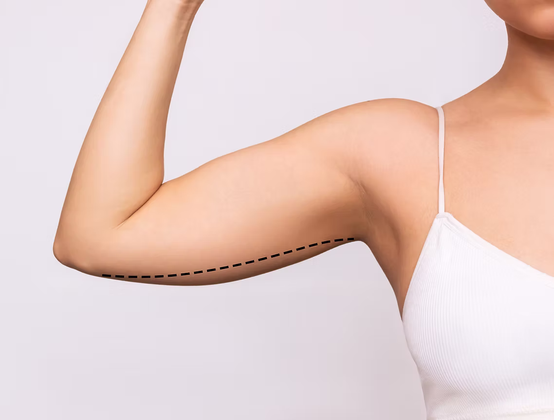 arm-lift-procedure