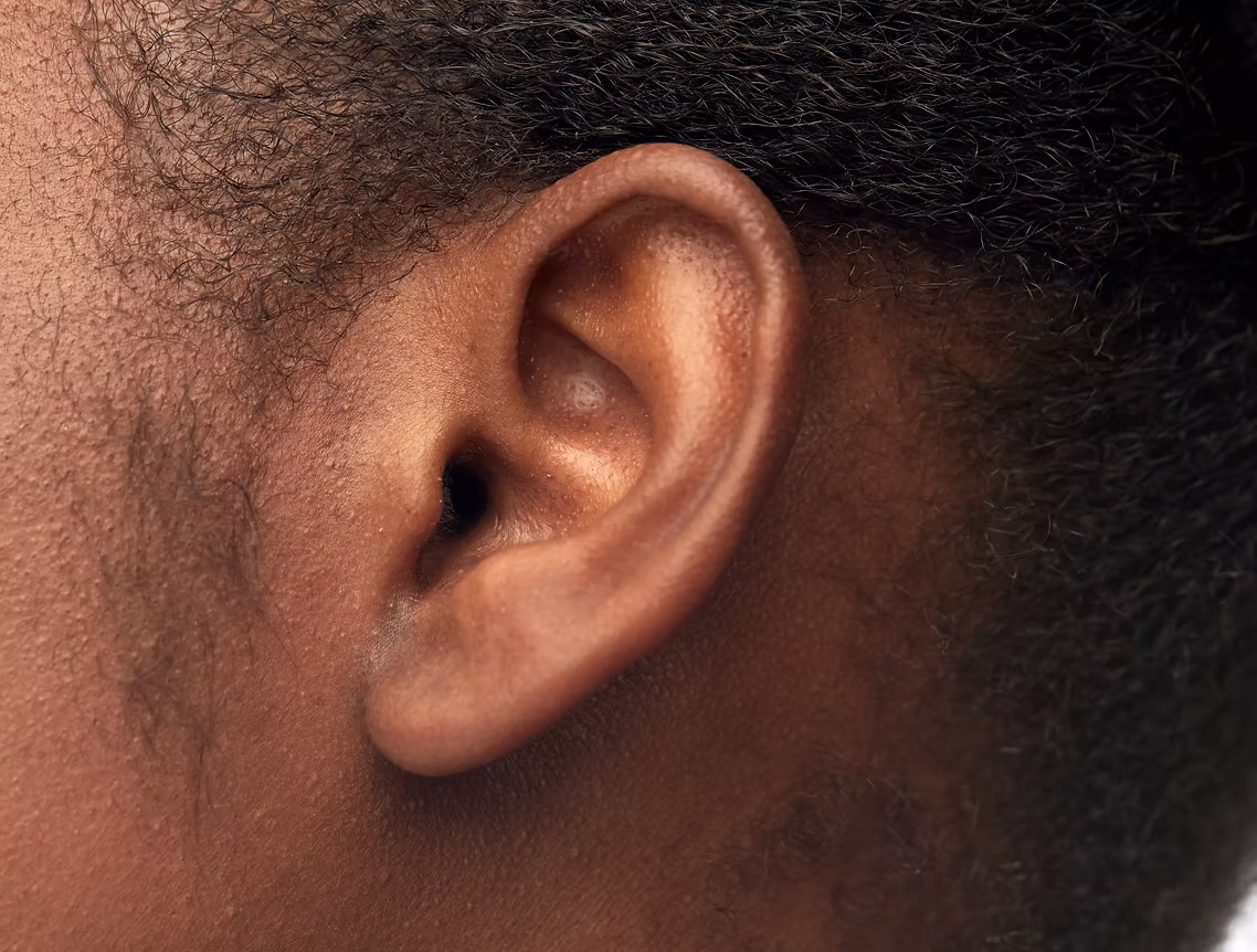 Ear Reshaping