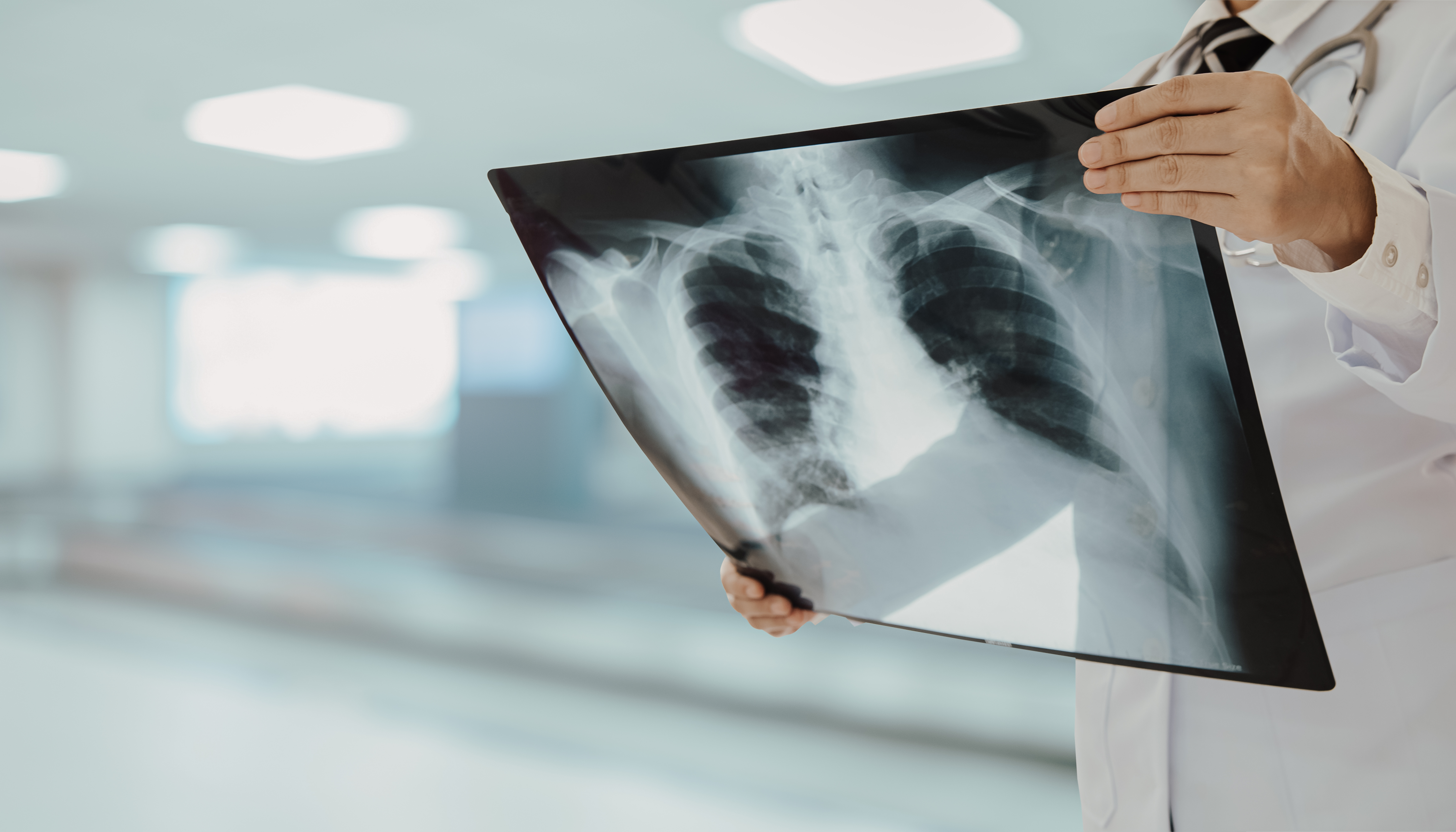 lung xray