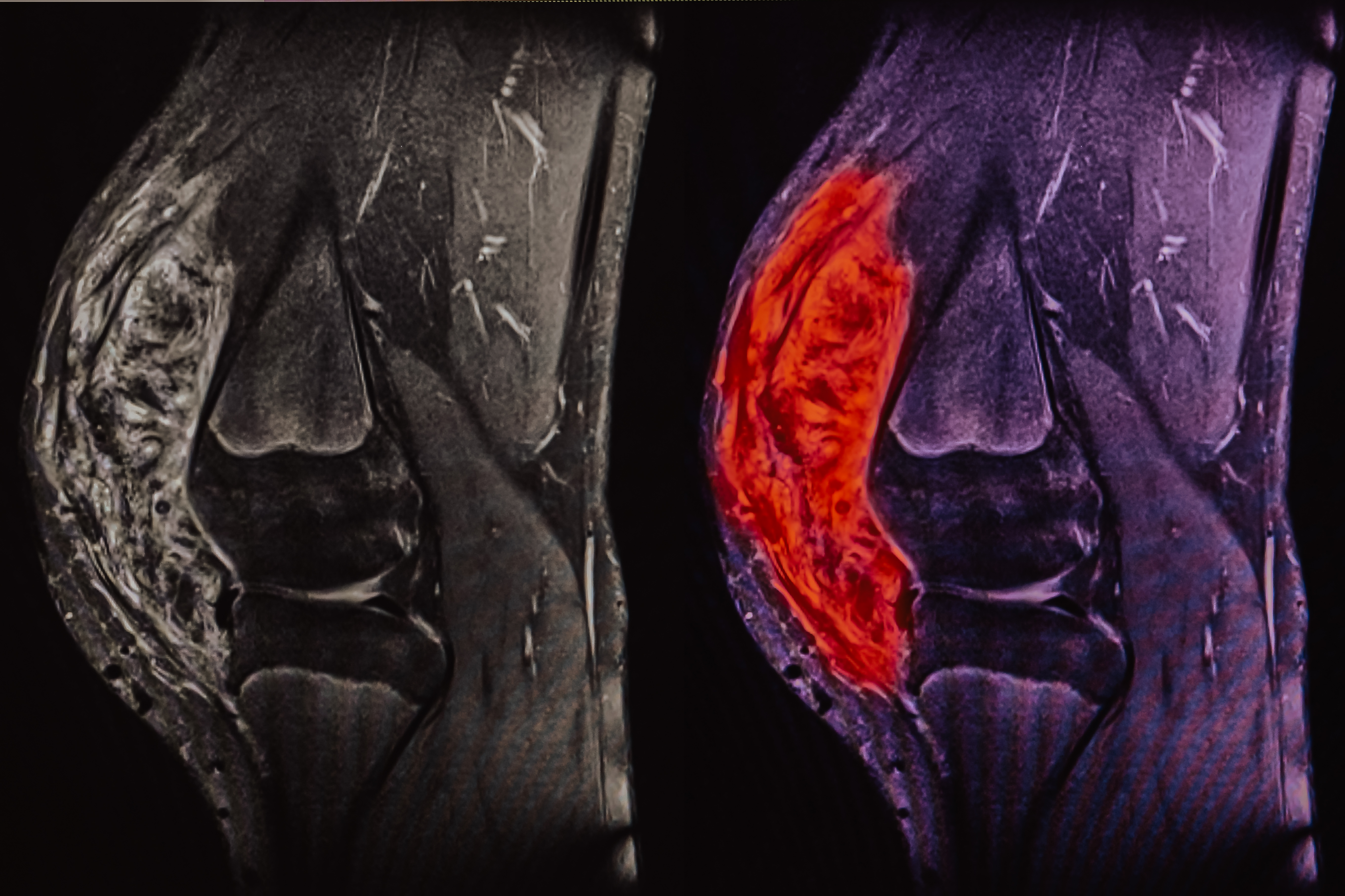 sarcoma